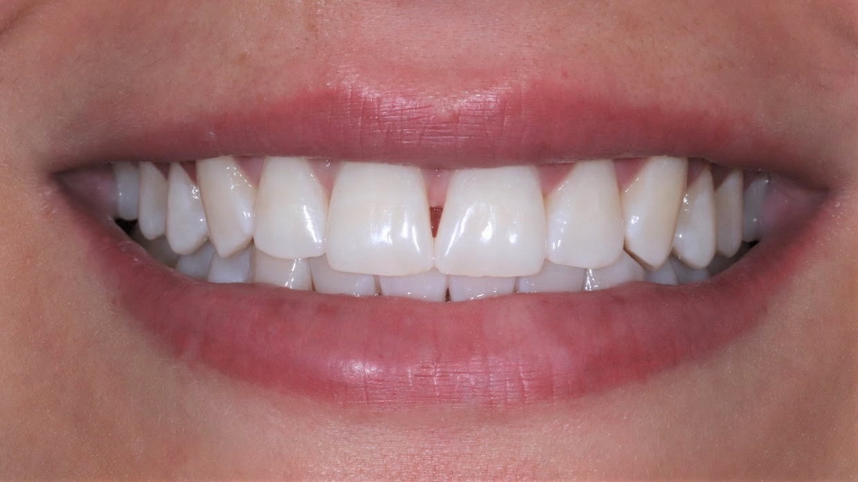 Bleaching München Zahnbehandlung Zahnbleaching Zähne aufhellen Ergebnis