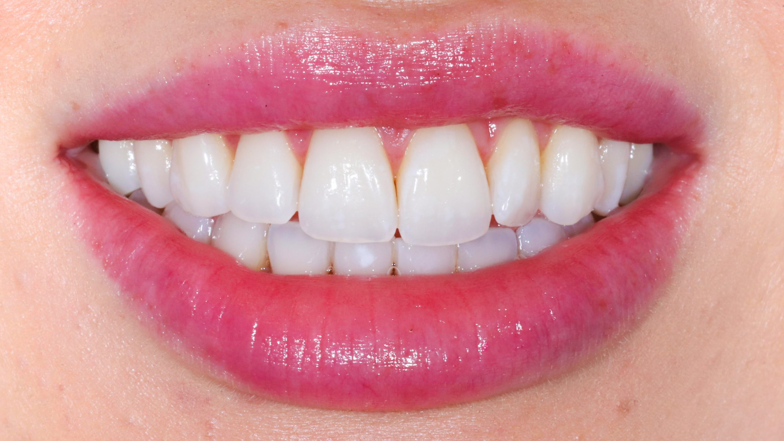 bleaching-munich-dental-bleach-clinic-results-after