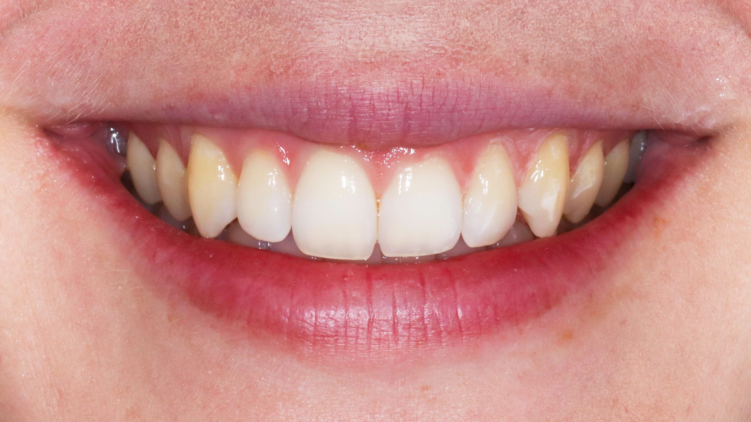 bleaching-munich-dental-bleach-clinic-results-before