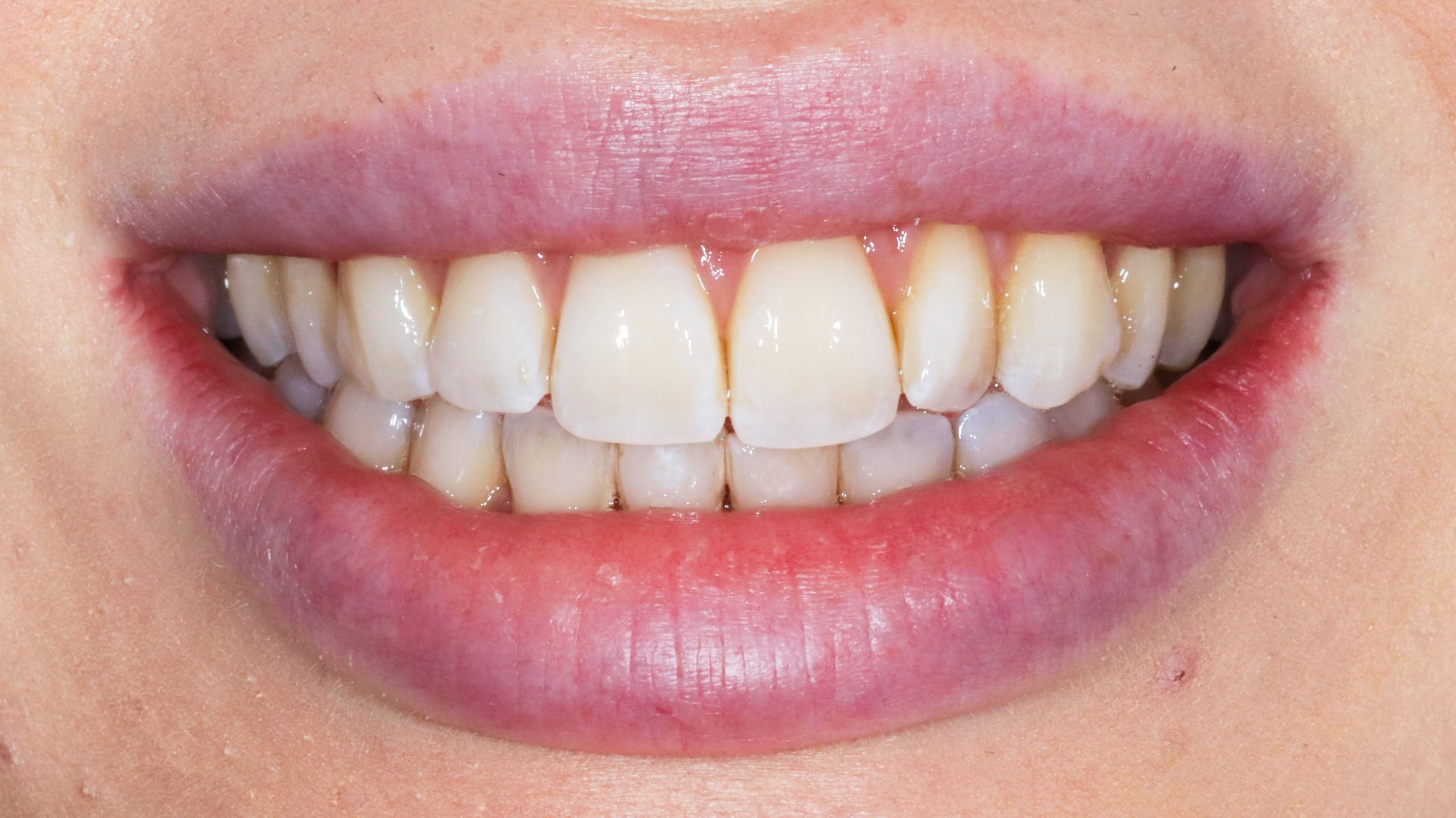bleaching-munich-dental-bleach-clinic-results-before