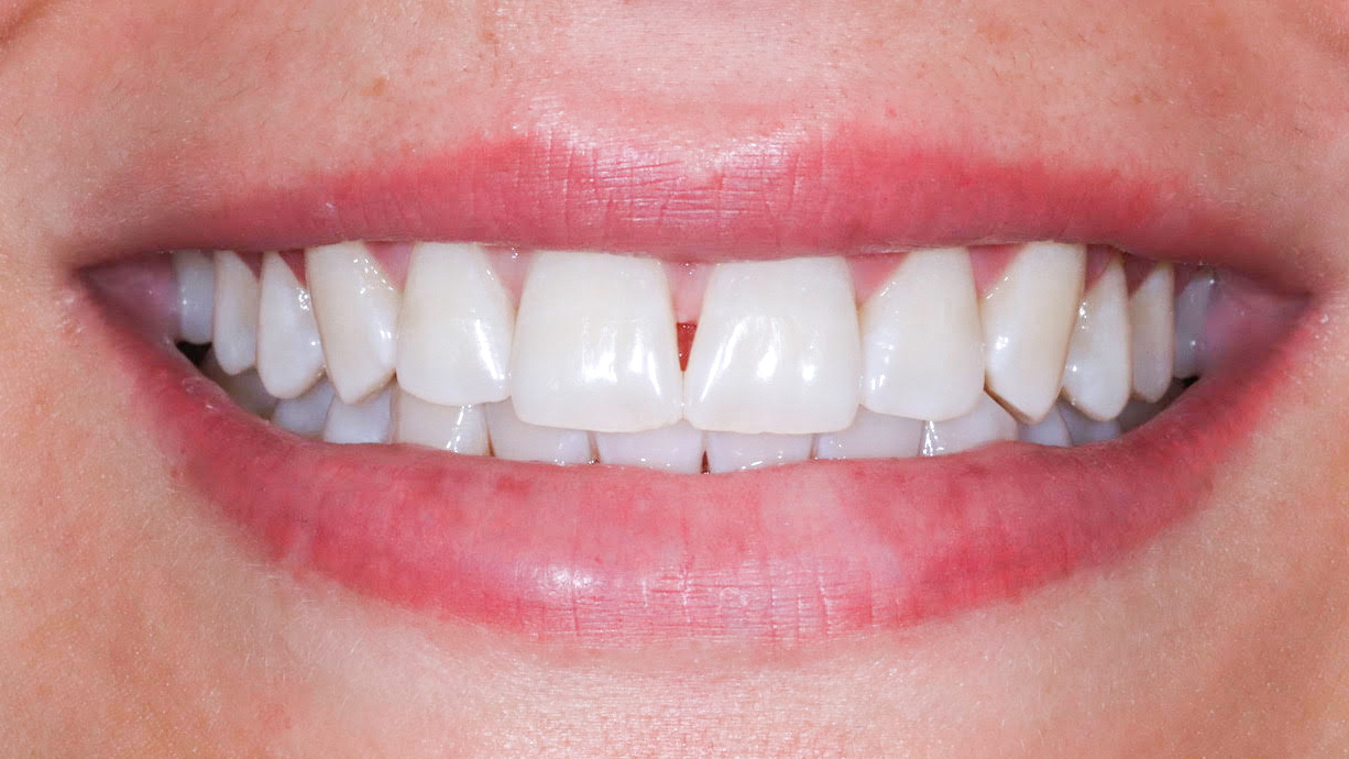 bleaching-münchen-zahnaufhellung-zähne-bleichen-behandlungsergebnis-nachher