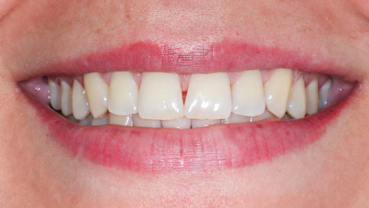 bleaching-münchen-zahnaufhellung-zähne-bleichen-behandlungsergebnis-vorher