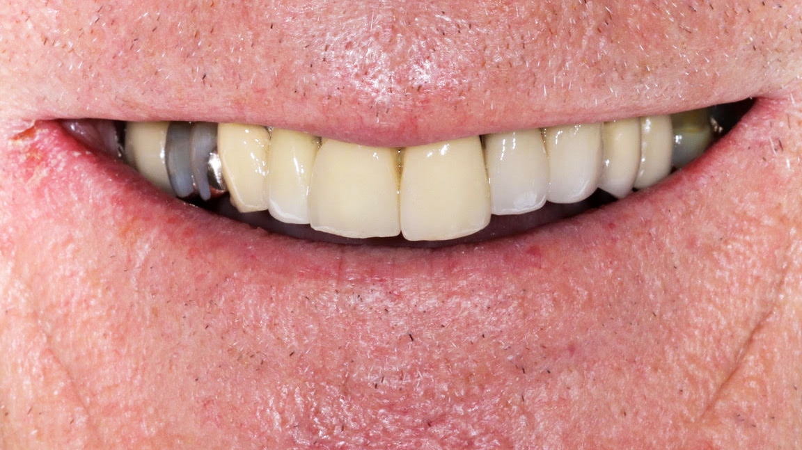 dental-implants-ceramic-crowns-munich-treatment-result-before