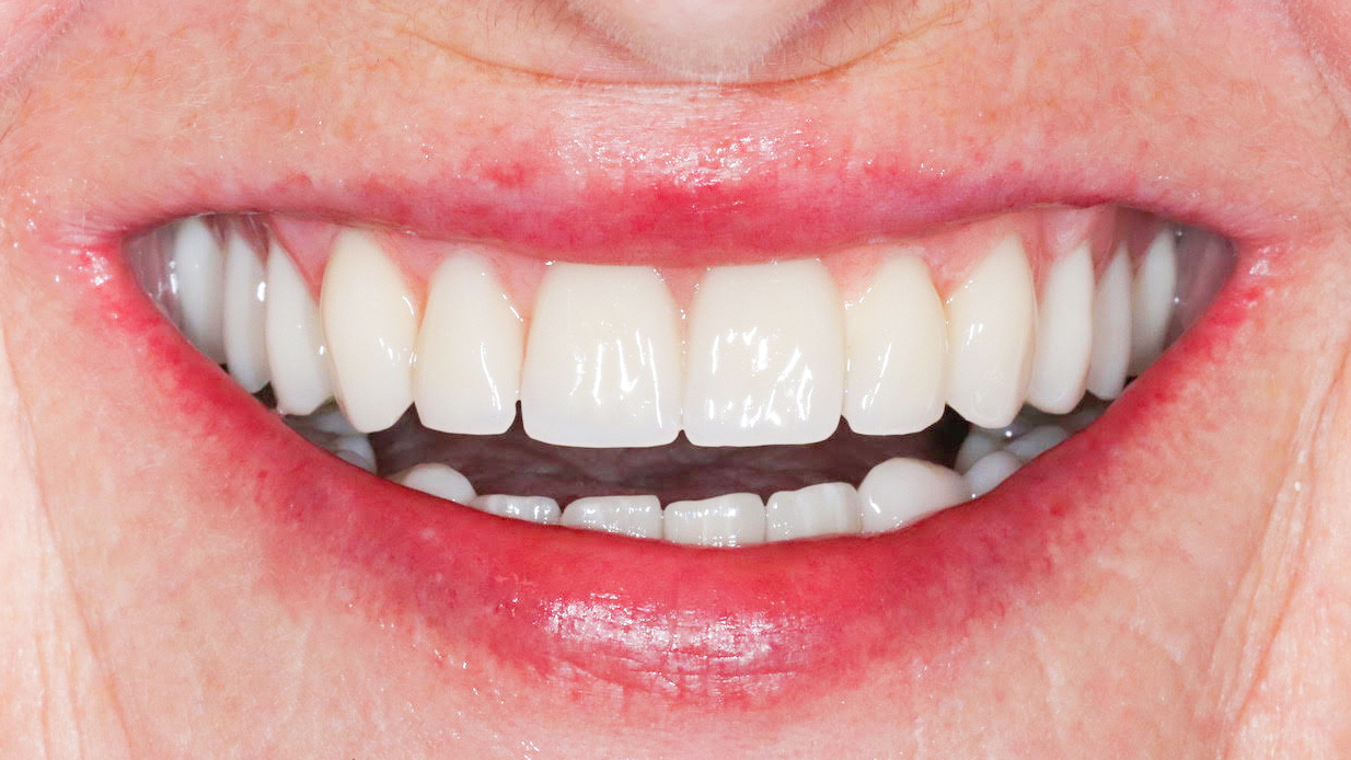 dental-restoration-munich-treatmentresult-after
