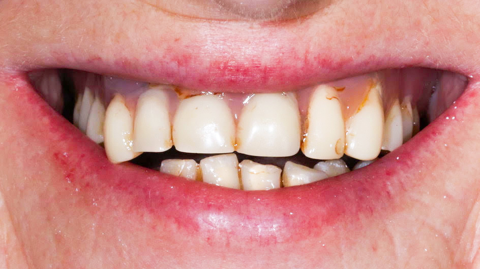 dental-restoration-munich-treatmentresult-before