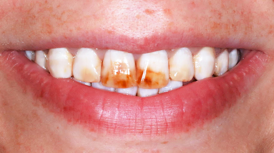 veneers-munich-ceramic-veneer-dental-treatment-result-before