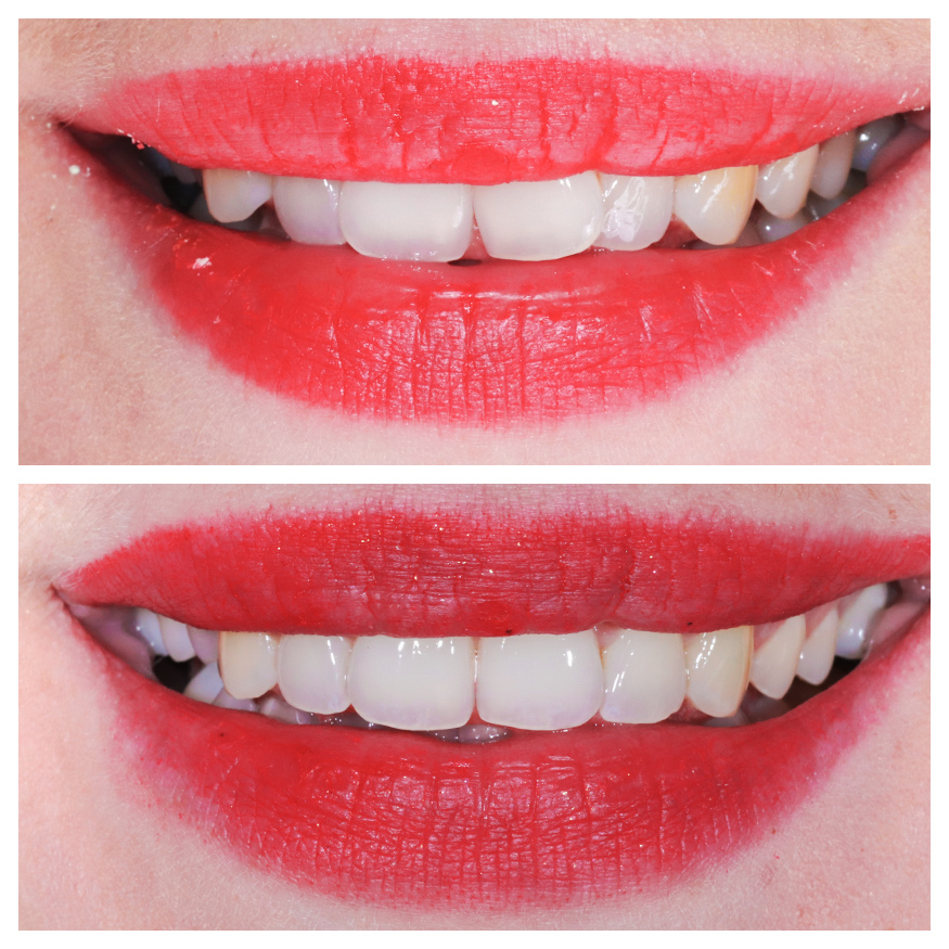 veneers-munich-dental-veneers-dentist-before-after-treatment-results
