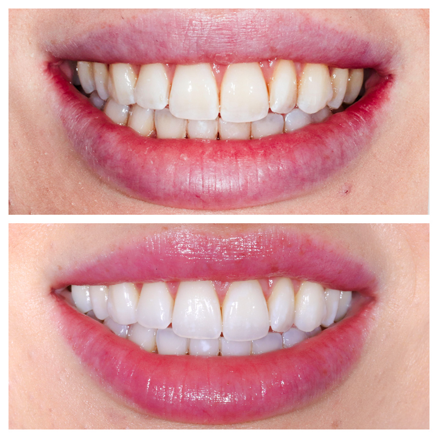 teeth-belaching-munich-dental-bleaching-dentist-munich-before-after-treatement-showcase