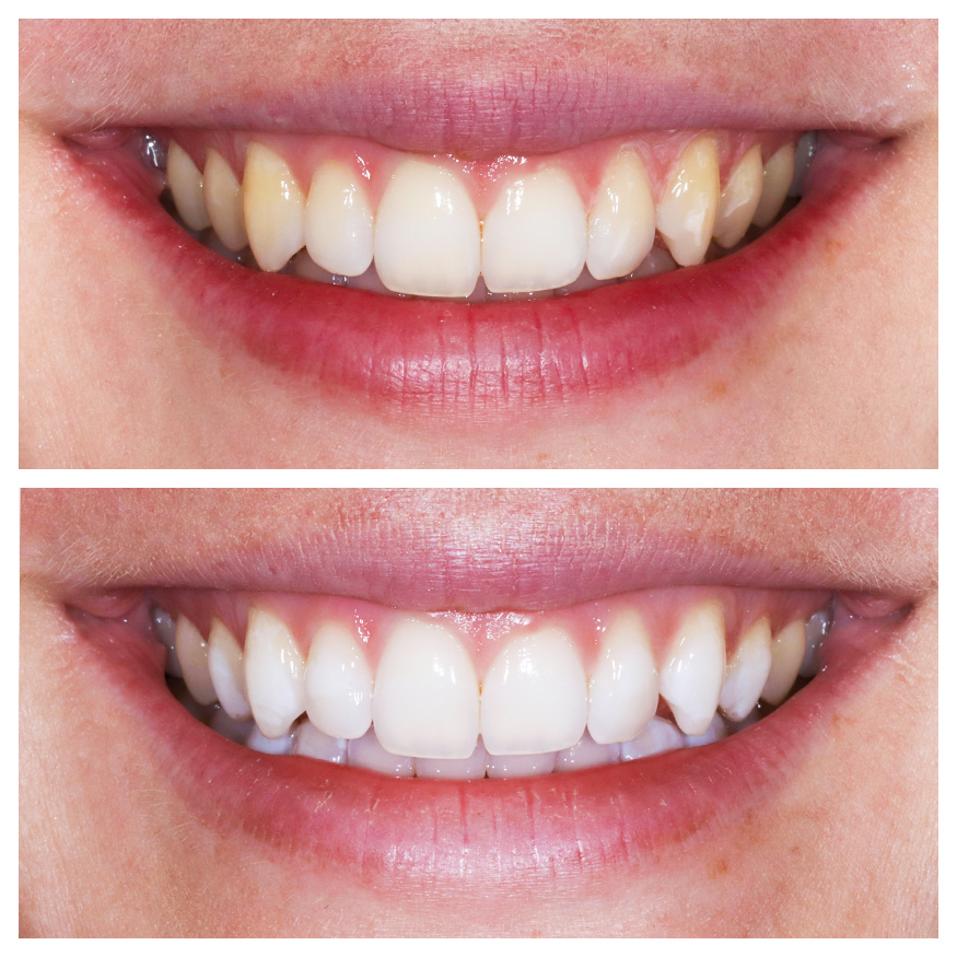 invisalign-munich-transparent-aligner-therapy-treatment-result-before-after-dentist
