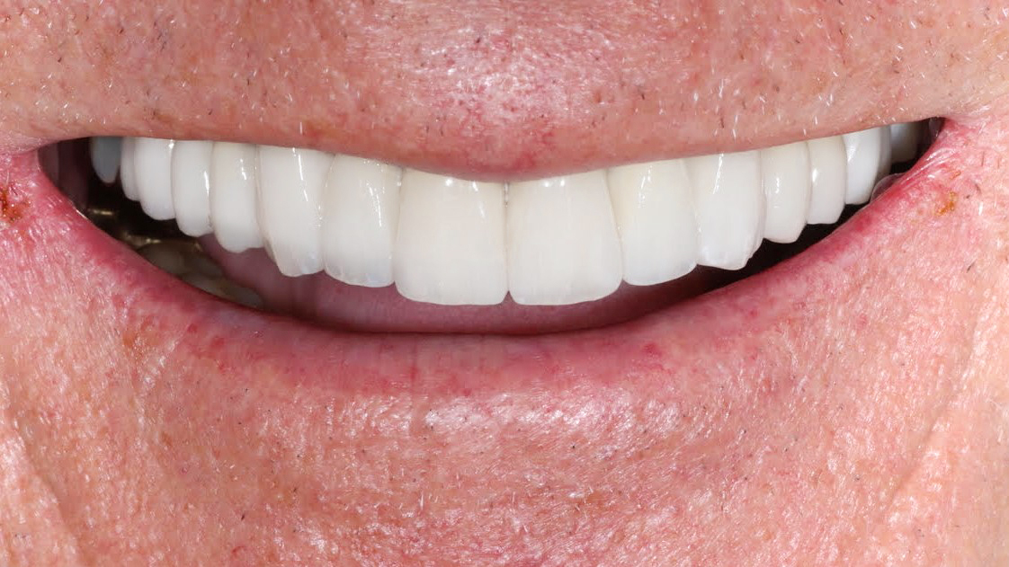 dental-implants-ceramic-crowns-treatment-result-after