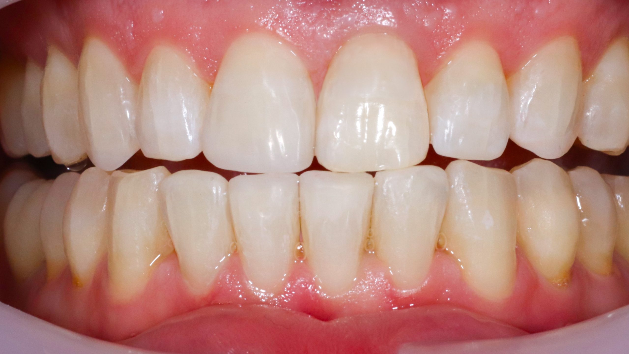 dentist-munich-dental-aesthetics-correction-of-teeth-length-treatment-result-after
