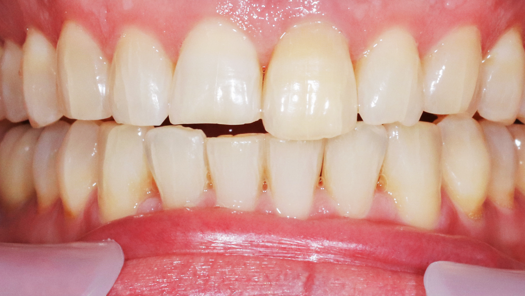 dentist-munich-dental-aesthetics-correction-of-teeth-length-treatment-result-before