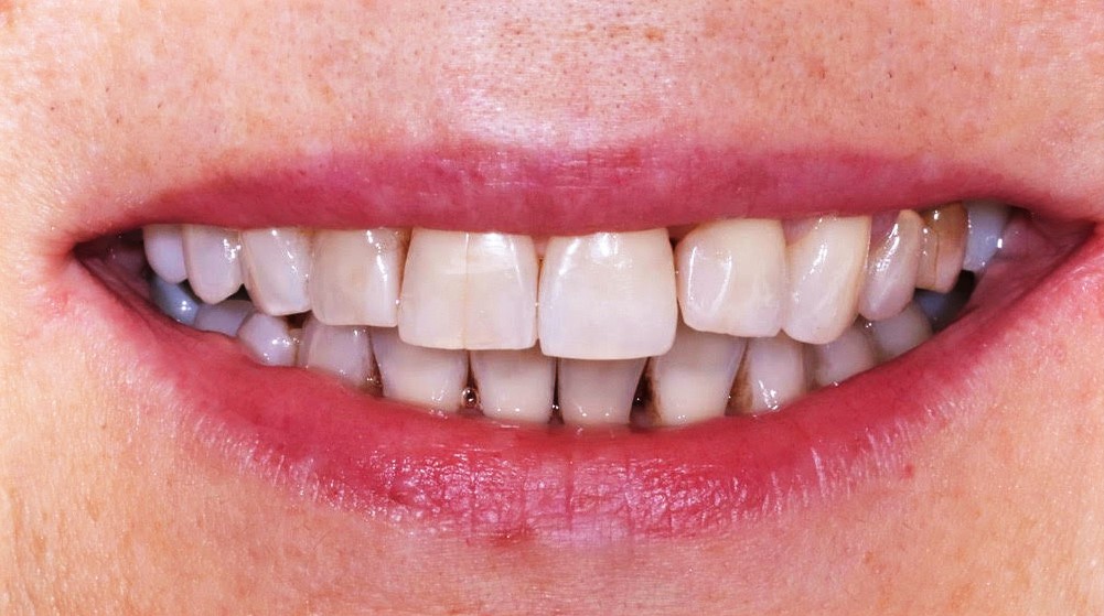 invisalign-aligner-thearaphy-treatment-result-dental-aligners-before