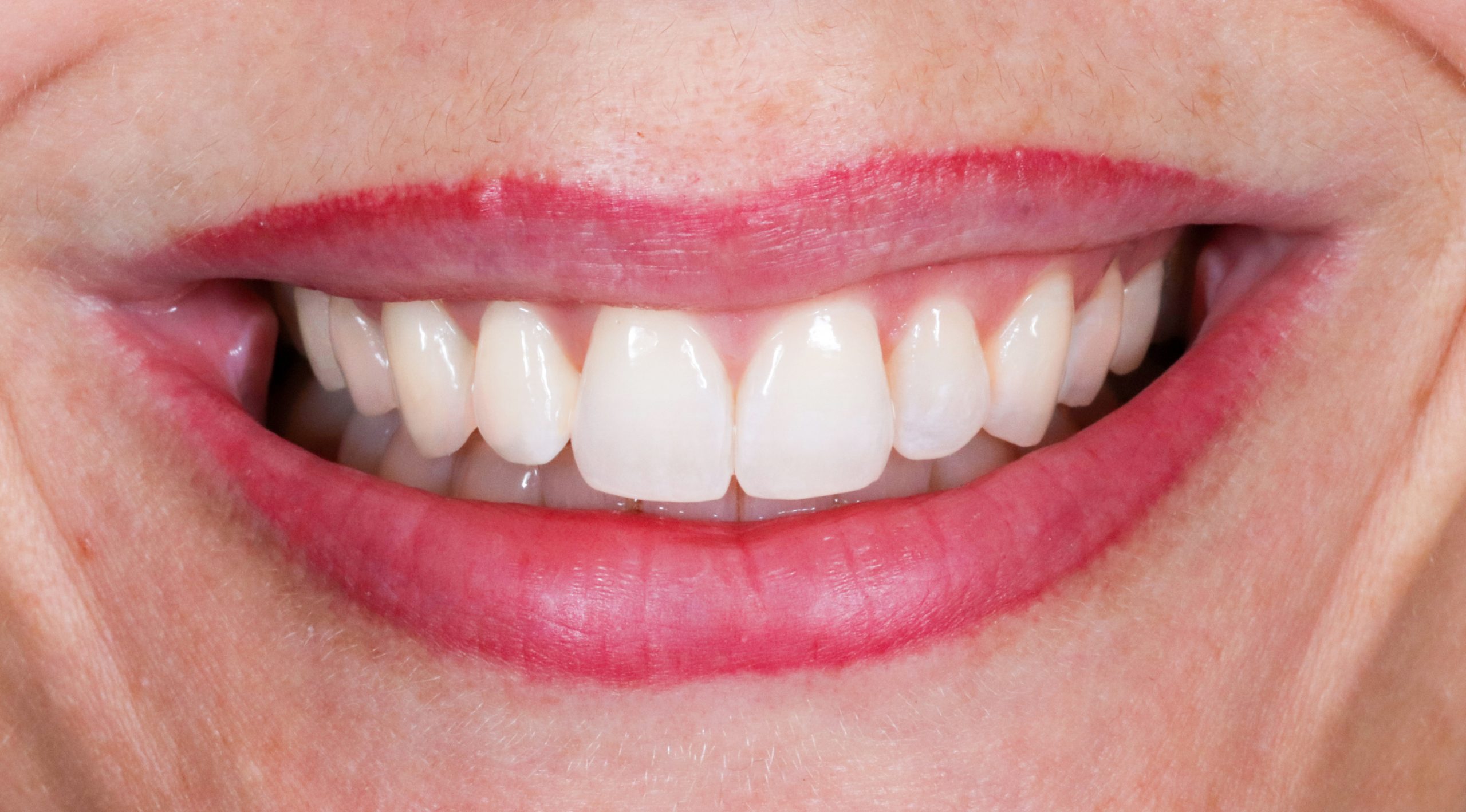invisalign-munich-treatment-result-after-invisible-aligners