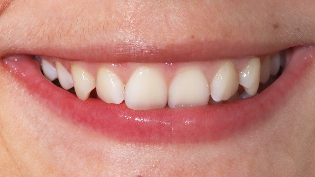 invisalign-treatment-result-before-dentist-munich-zoom