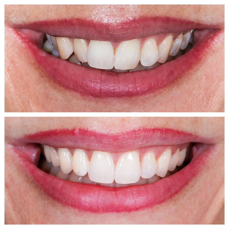 Dental-Bleaching-Munich-teeth-bleaching-dentist-munich-treatment-result-before-after