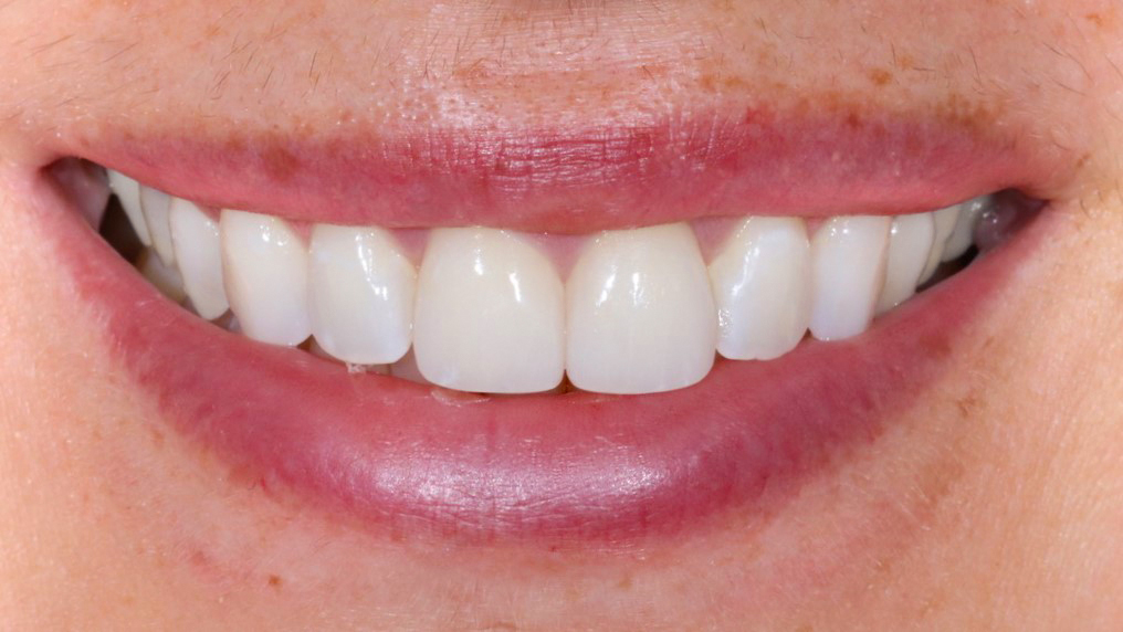 veneers-and-bleaching-treatment-result-after-dentist-munich