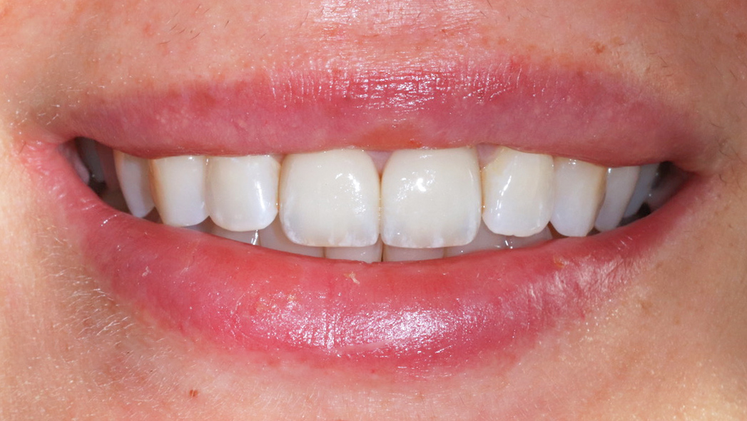 veneers-and-bleaching-treatment-result-before-dentist-munich