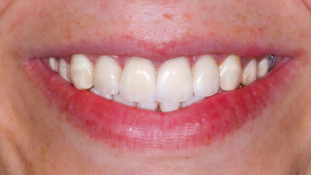 veneers-munich-ceramic-veneer-dental-treatment-result-after