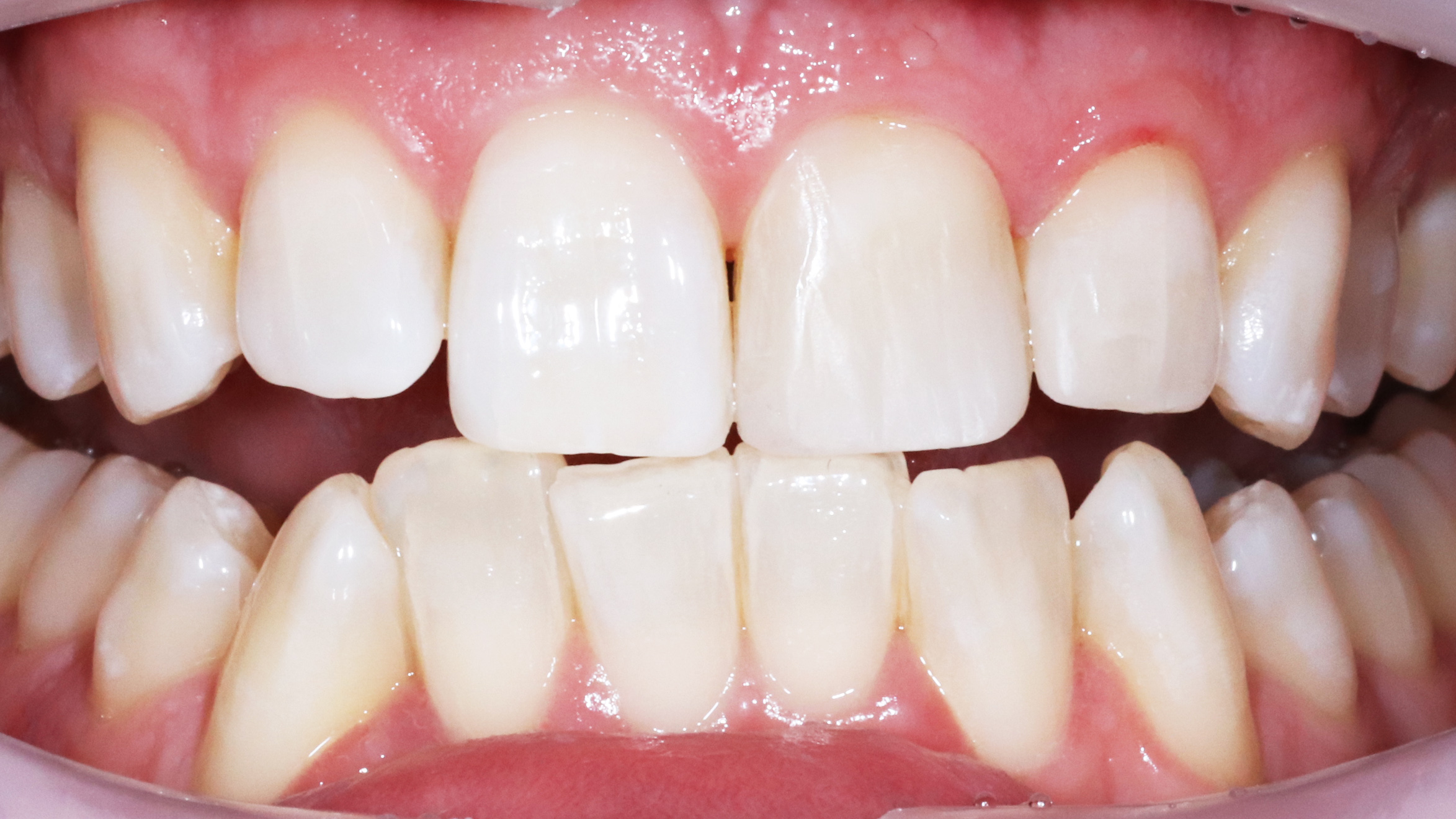 bleaching-tooth-whitening-dental-bleach-treatement-result-after