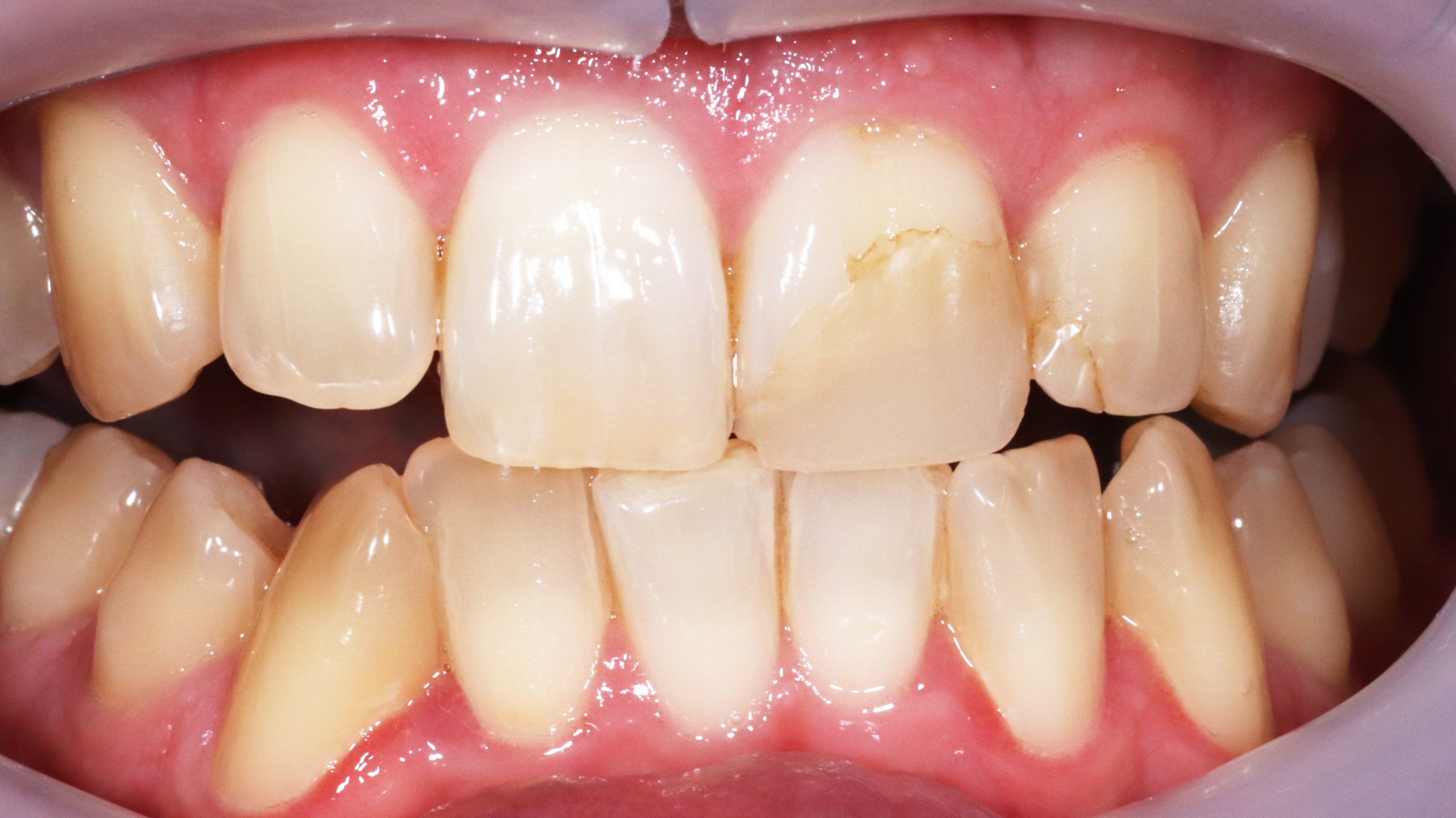 bleaching-tooth-whitening-dental-bleach-treatement-result-before