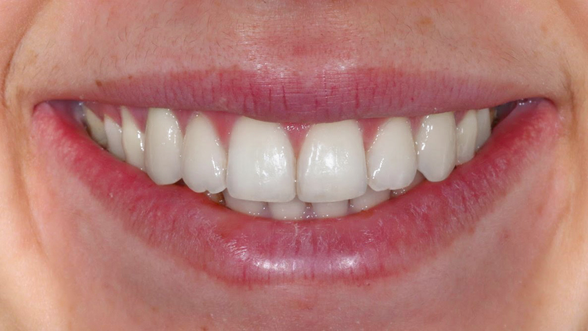 invisalign-munich-transparent-aligner-therapy-treatment-invisalign-result-after