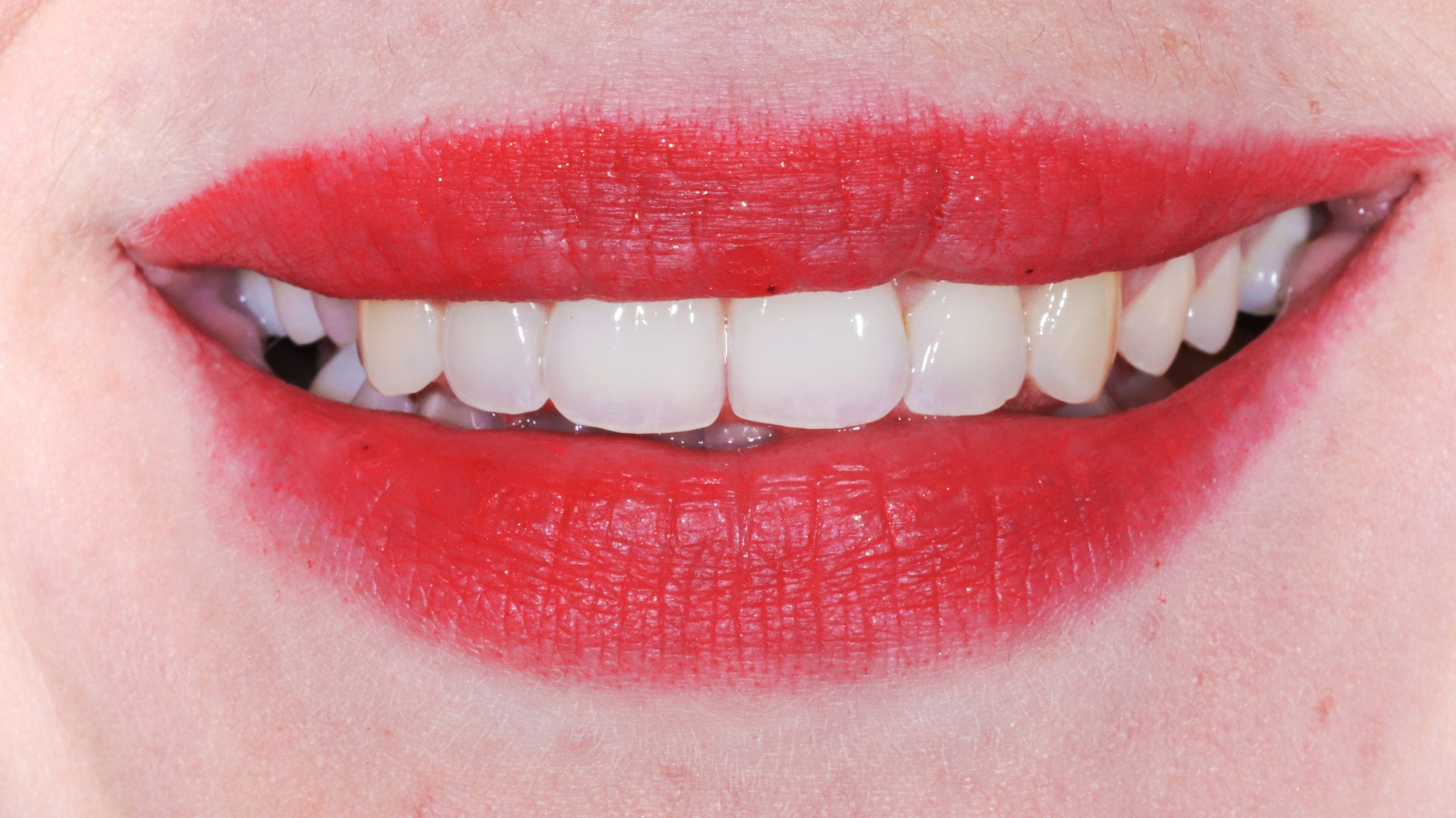 invisalign-munich-transparent-aligner-therapy-treatment-result-after