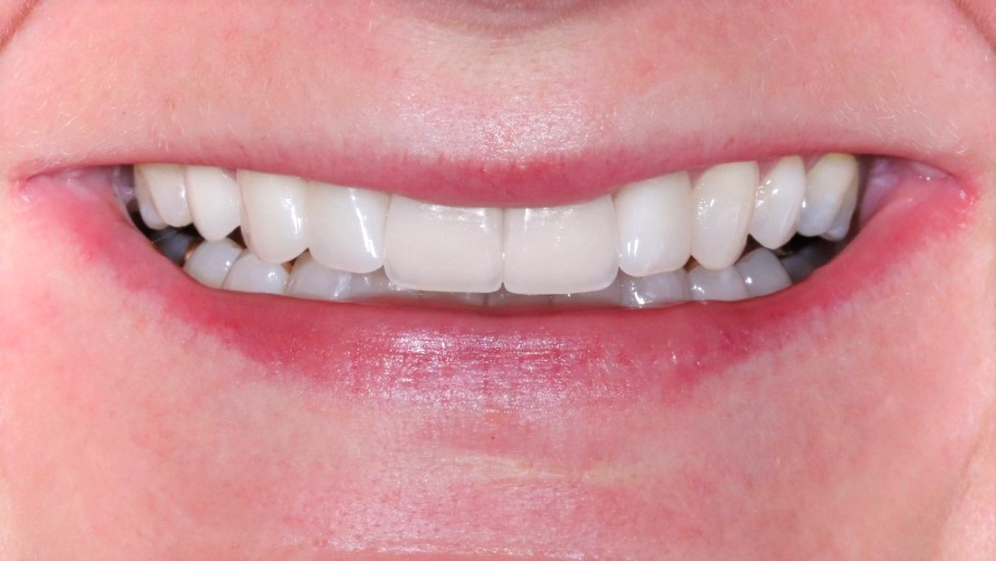 veneers-and-bleaching-dental-veneer-dental-bleach-munich-treatment-result-after