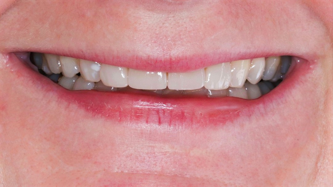 veneers-and-bleaching-dental-veneer-dental-bleach-munich-treatment-result-before