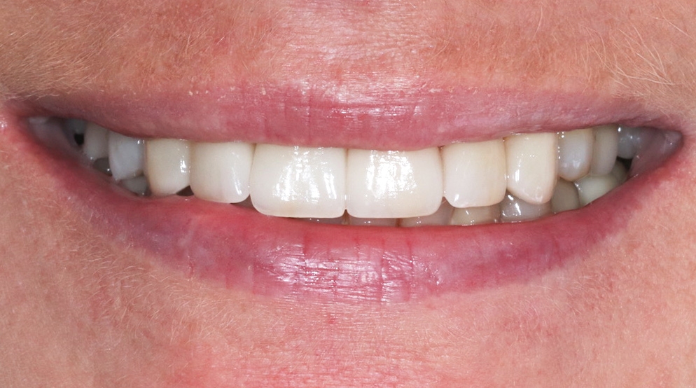 veneers-munich-before-and-after-treatment-result-after
