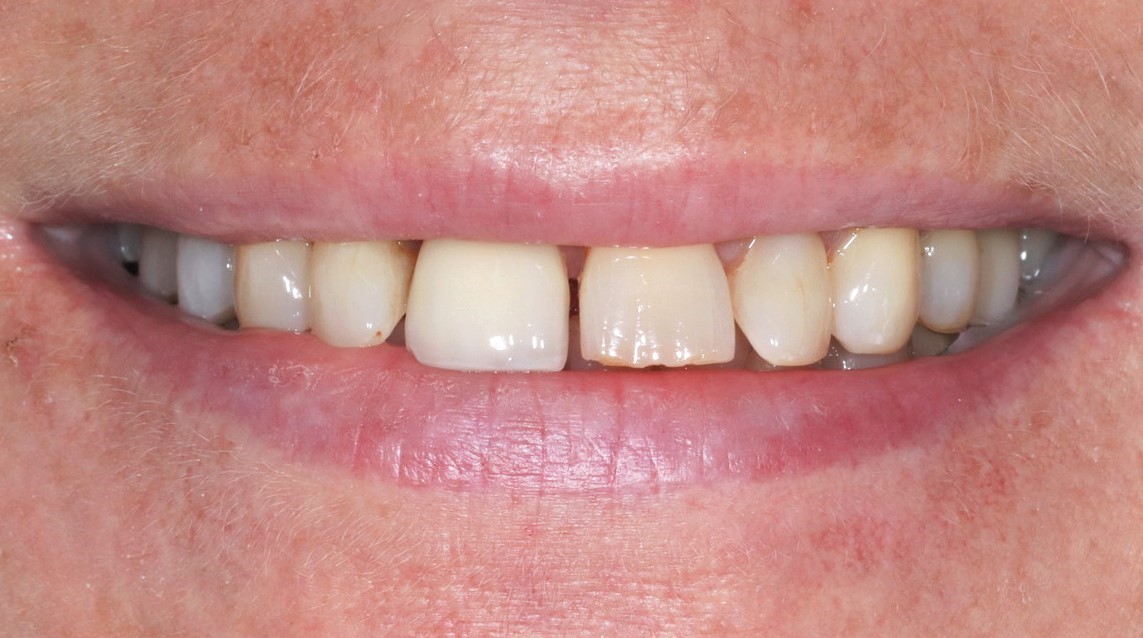 veneers-munich-before-and-after-treatment-result-before