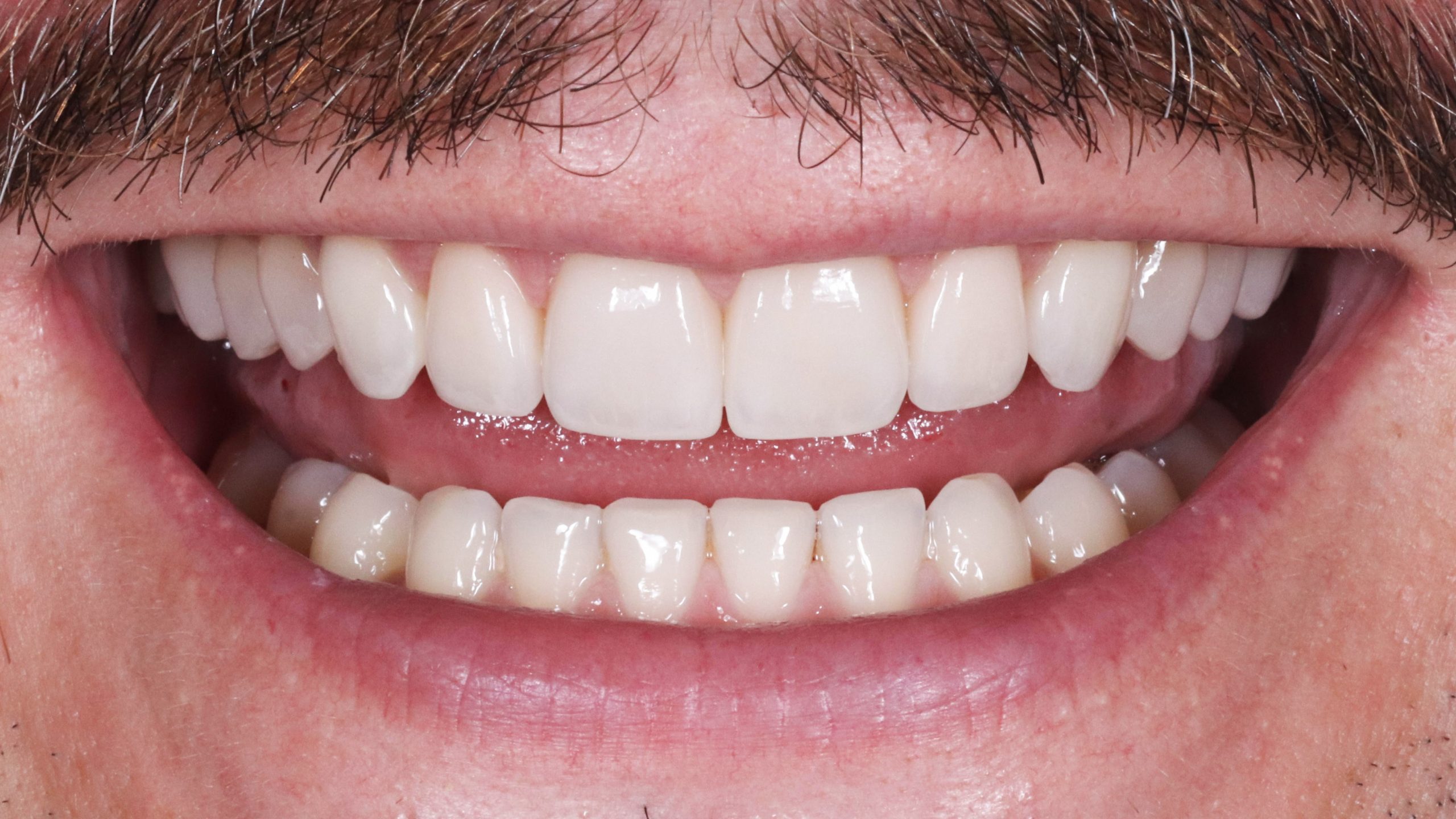 veneers-munich-bleaching-teeth-whitening-dental-bleaching-treatement-result-after