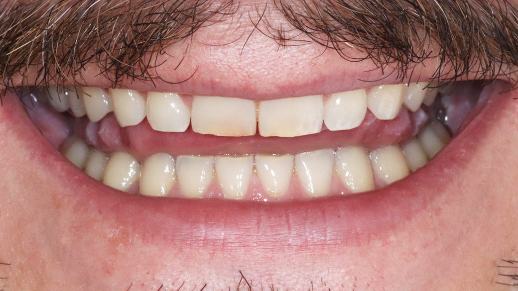 veneers-munich-bleaching-teeth-whitening-dental-bleaching-treatement-result-before