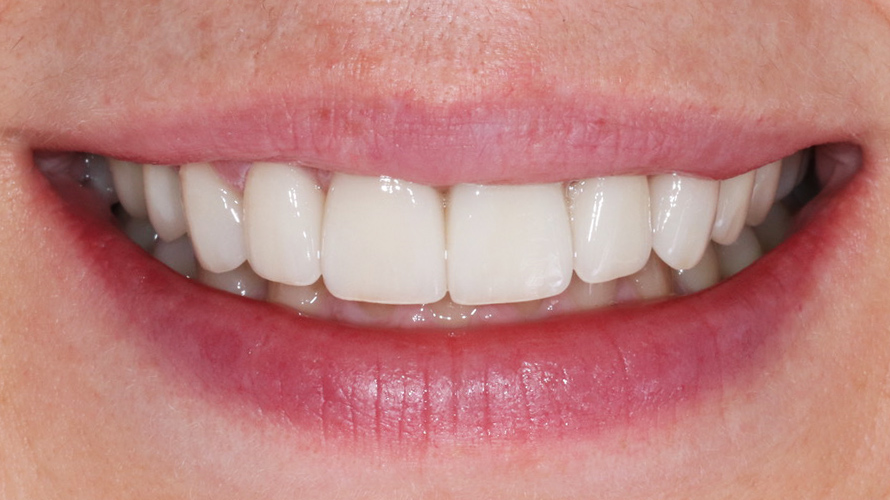 veneers-munich-dental-veneer-clinic-treatment-result-after