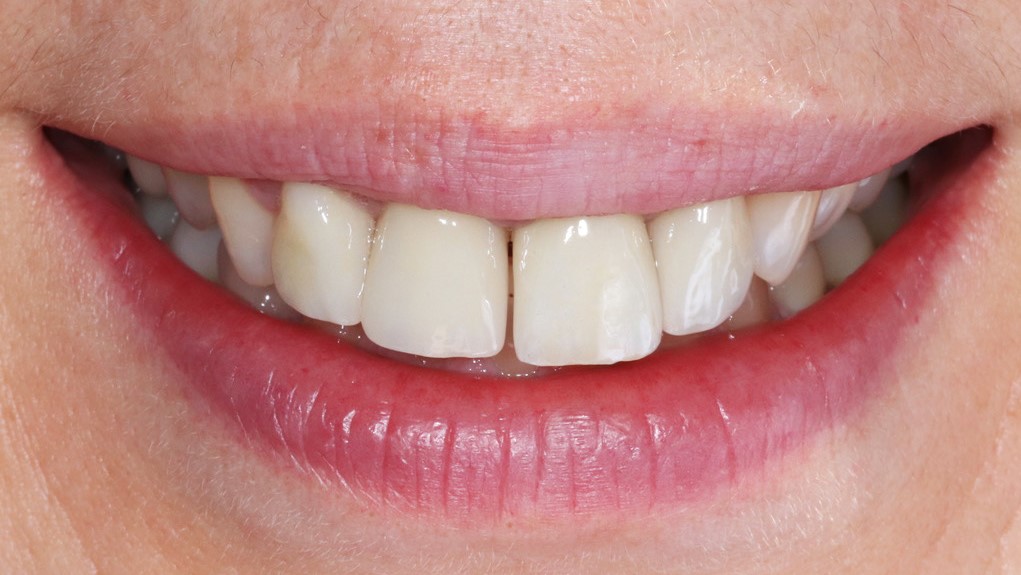 veneers-munich-dental-veneer-clinic-treatment-result-before