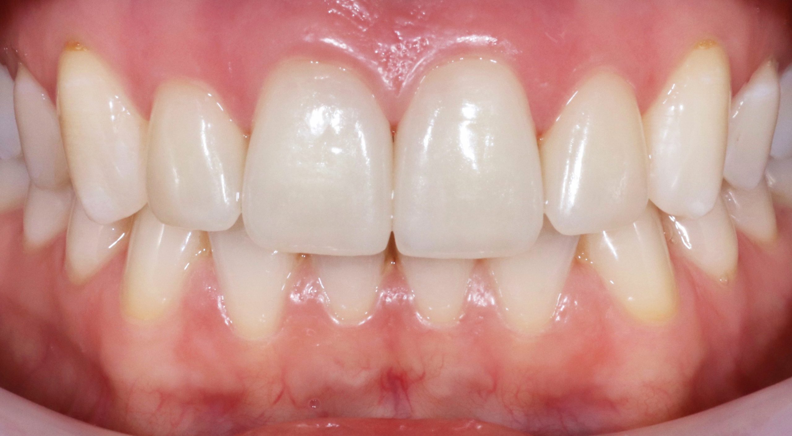 veneers-munich-dental-veneer-clinic-treatment-result-discoloration-after