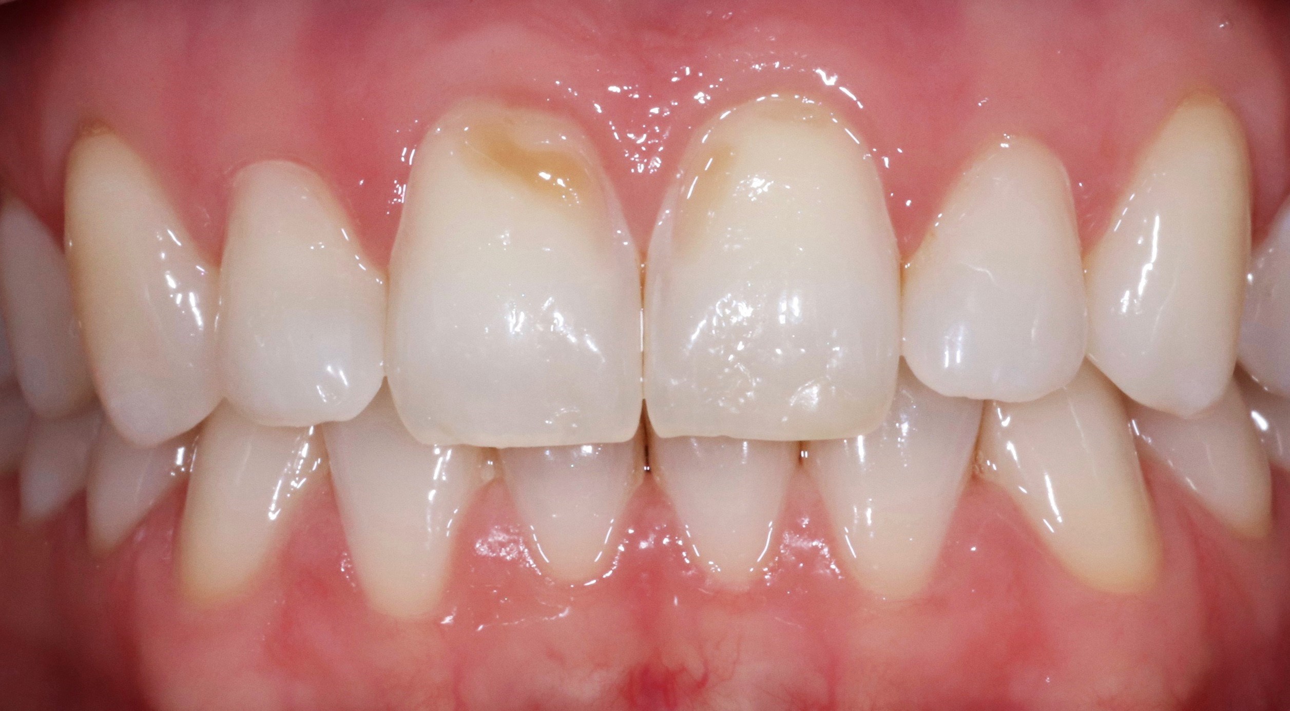 veneers-munich-dental-veneer-clinic-treatment-result-discoloration-before