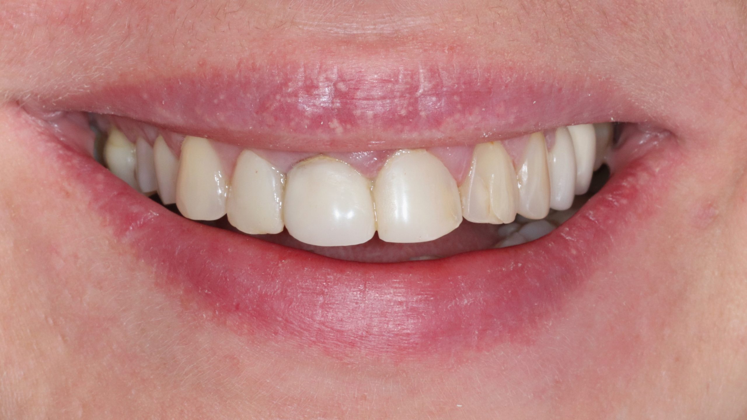 bleaching-and-veneers-dental-treatment-showcase-before