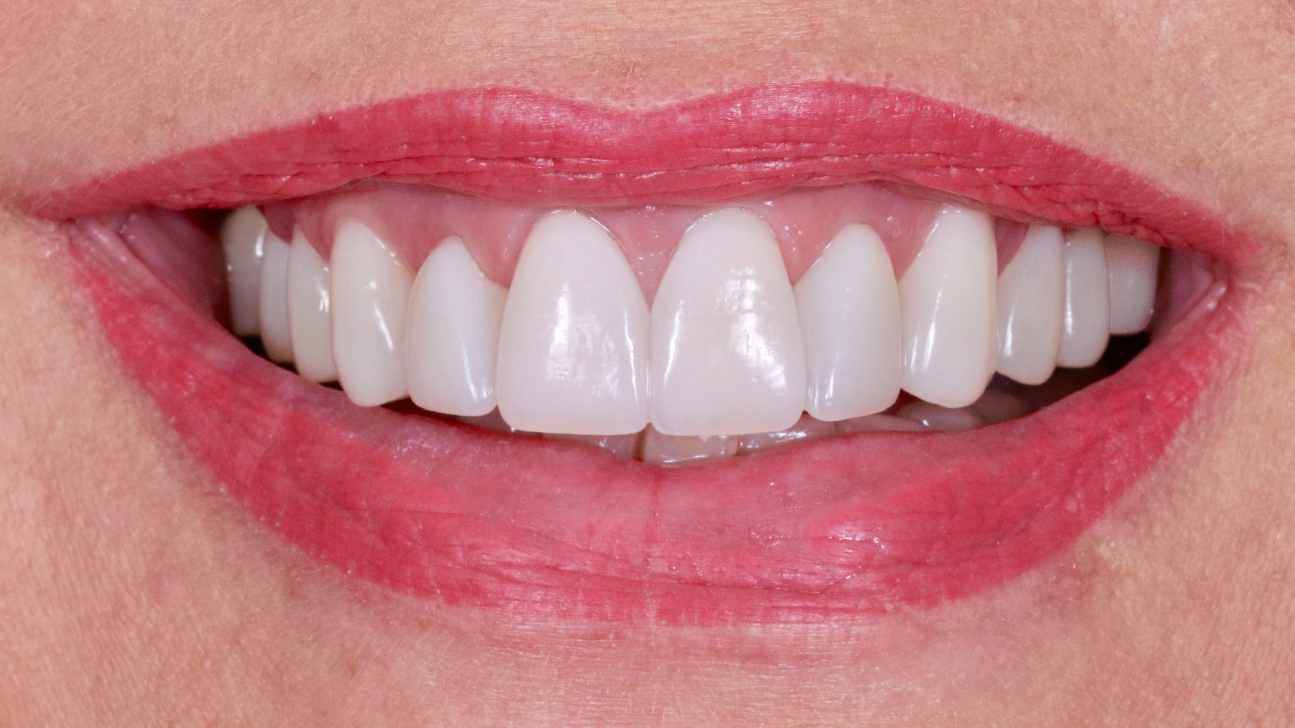 bleaching-and-veneers-treatment-result-dental-veneer-after