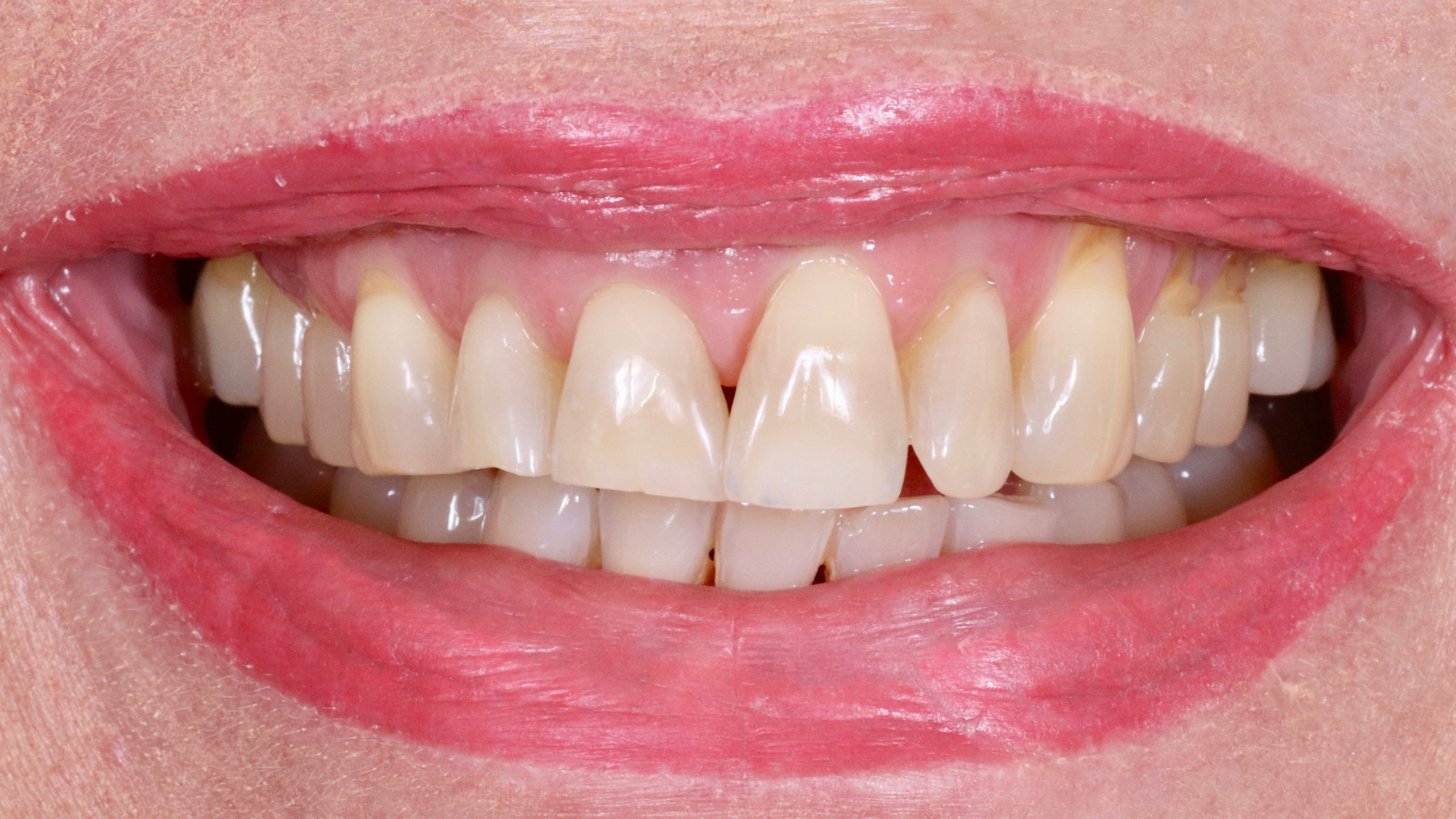 bleaching-and-veneers-treatment-result-dental-veneer-before