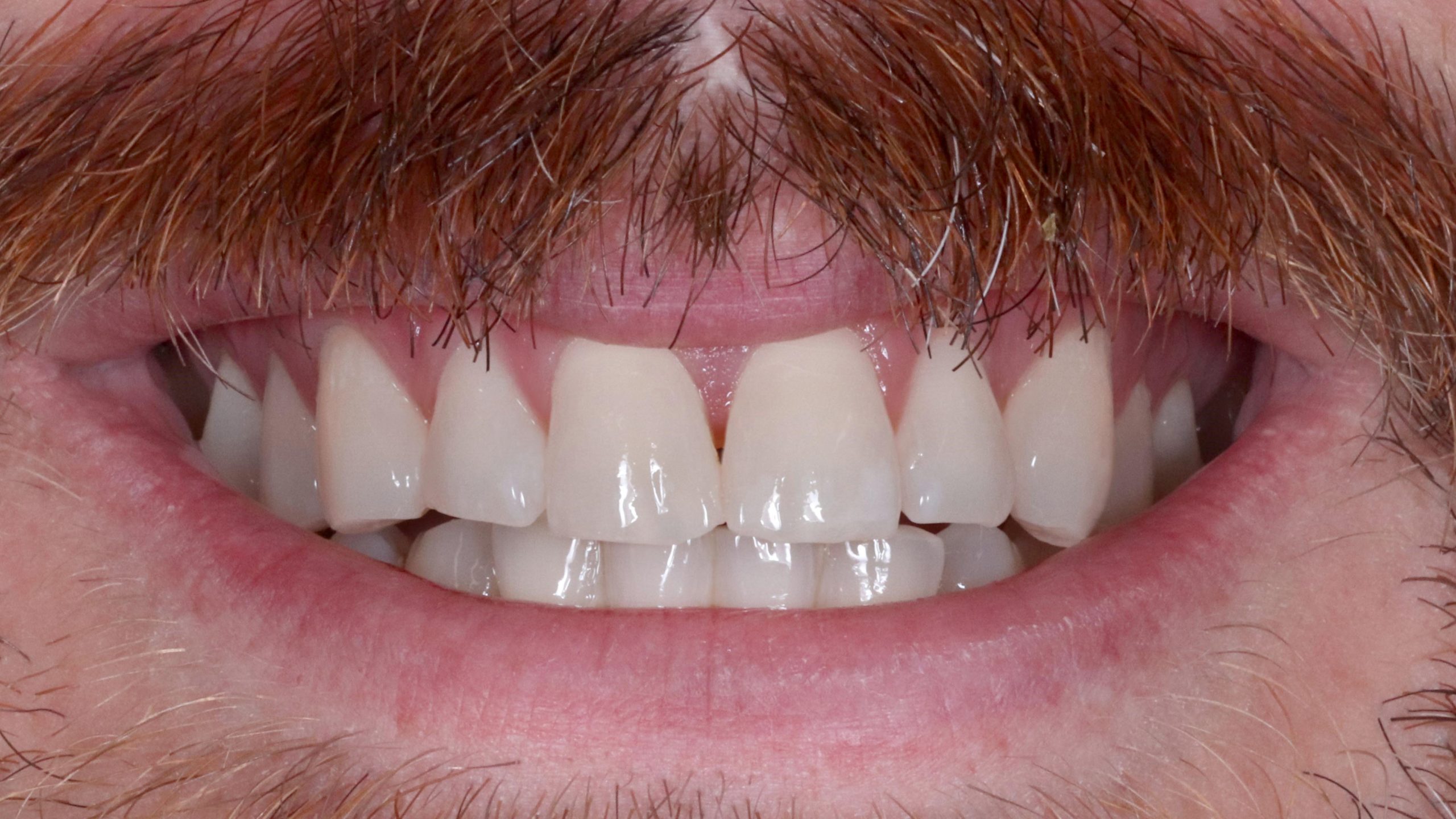 dental-bleaching-showcase-treatment-tesult-bleaching--after