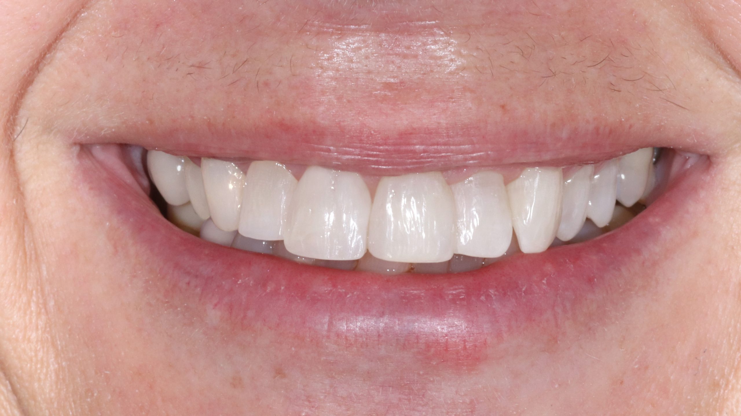 dental-bleaching-tooth-whitening-treatment-result-after