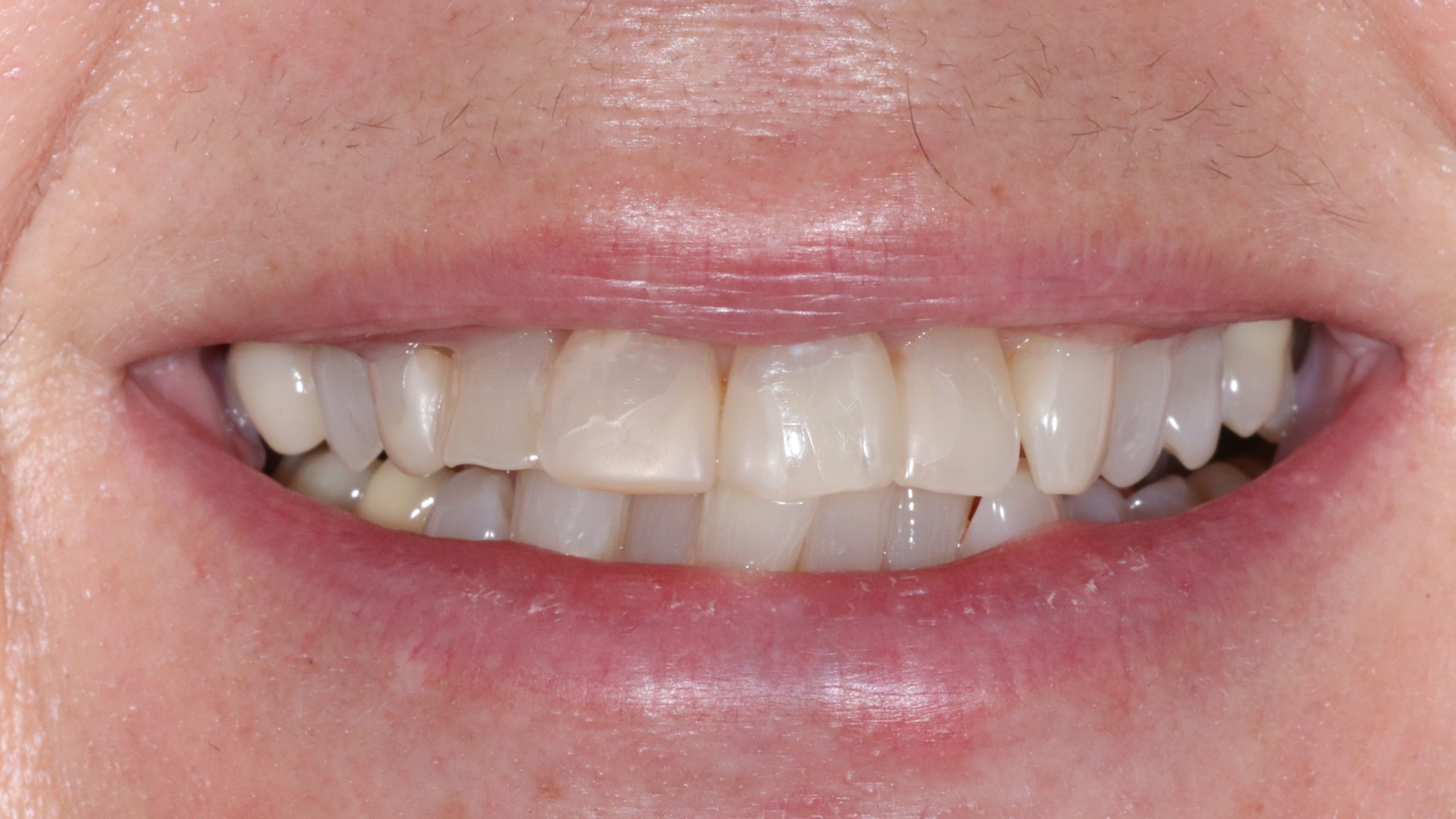 dental-bleaching-tooth-whitening-treatment-result-before