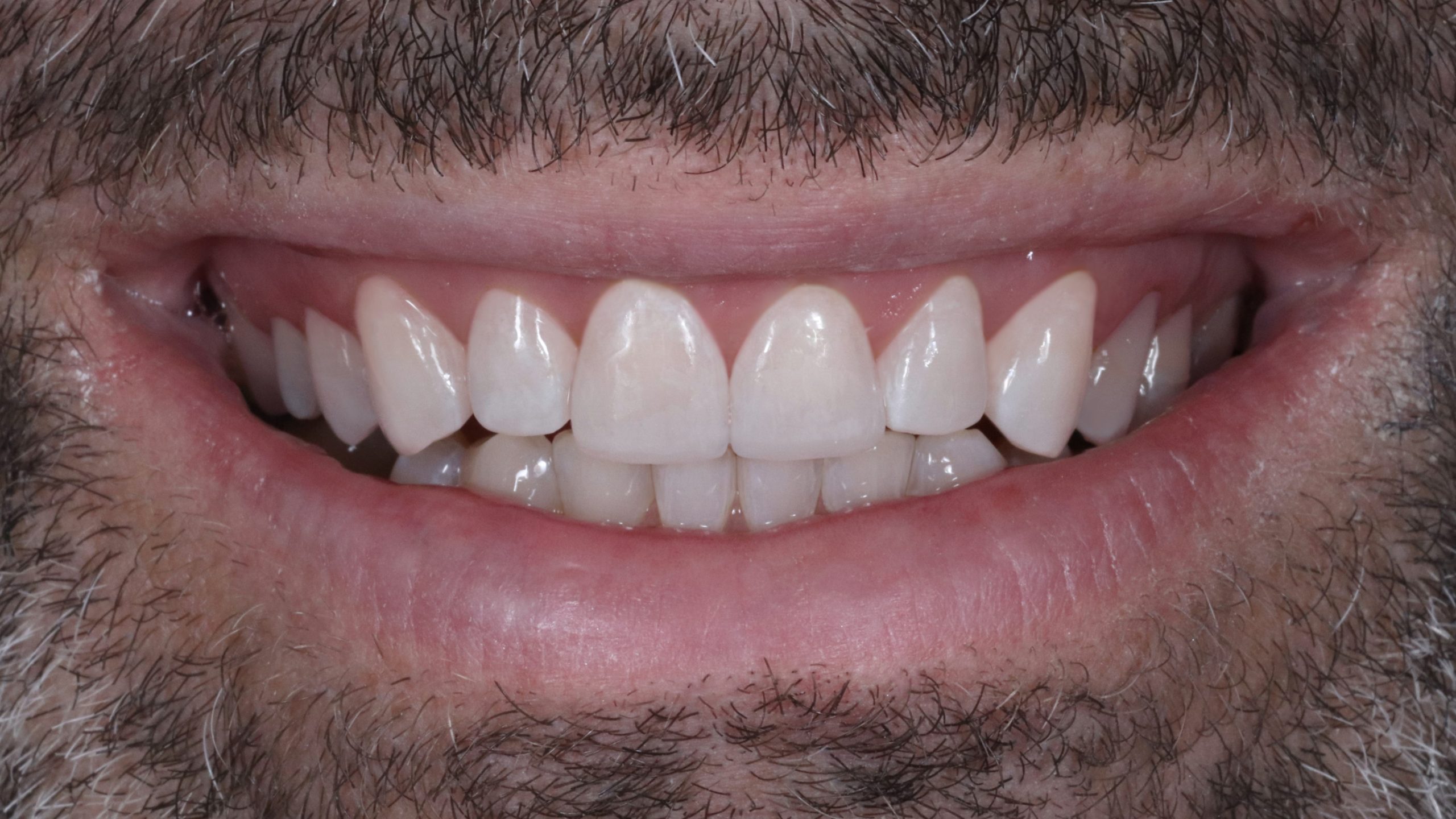 dental-bleaching-treatment-result-showcase-after