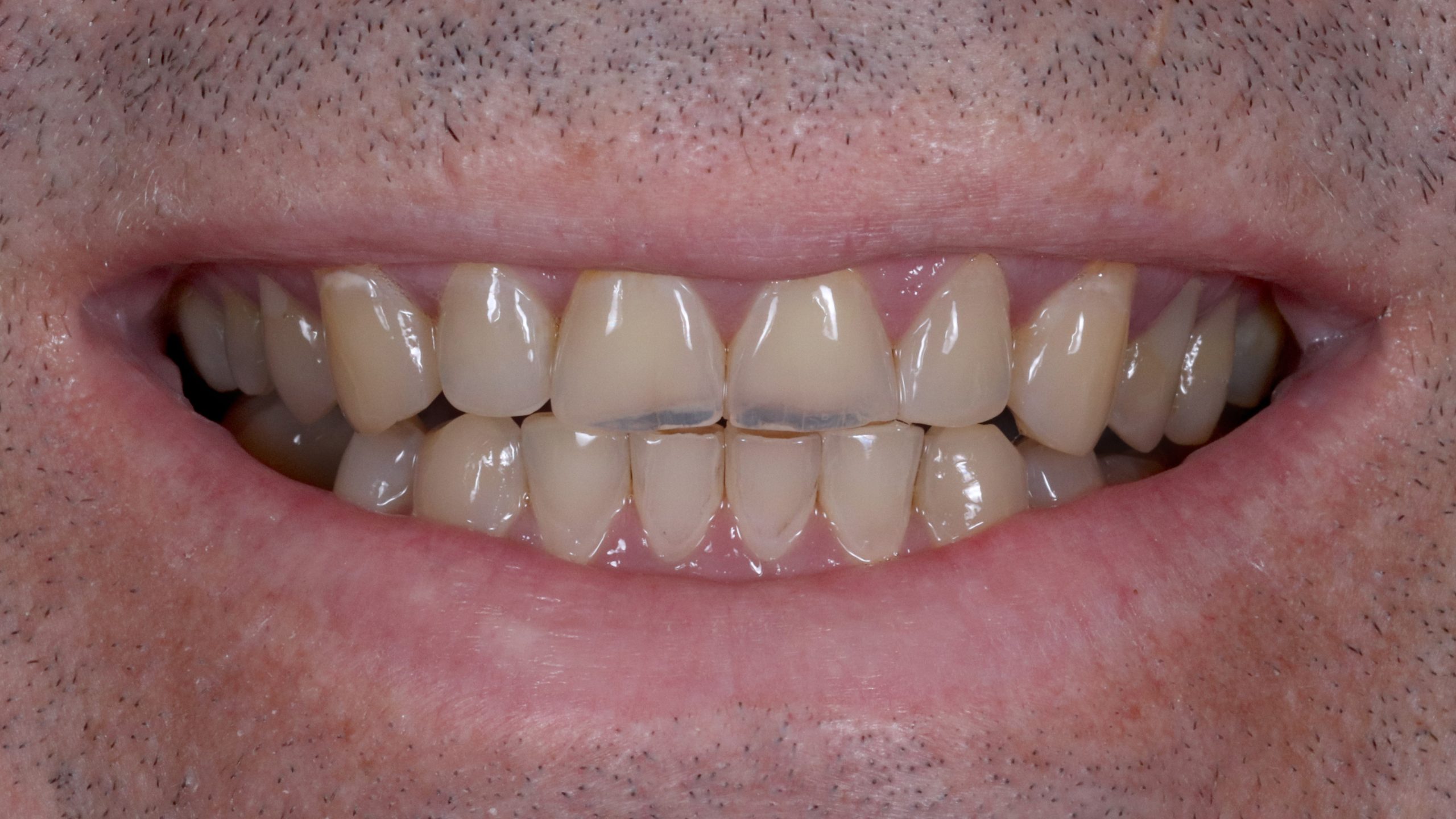 dental-bleaching-treatment-result-showcase-before