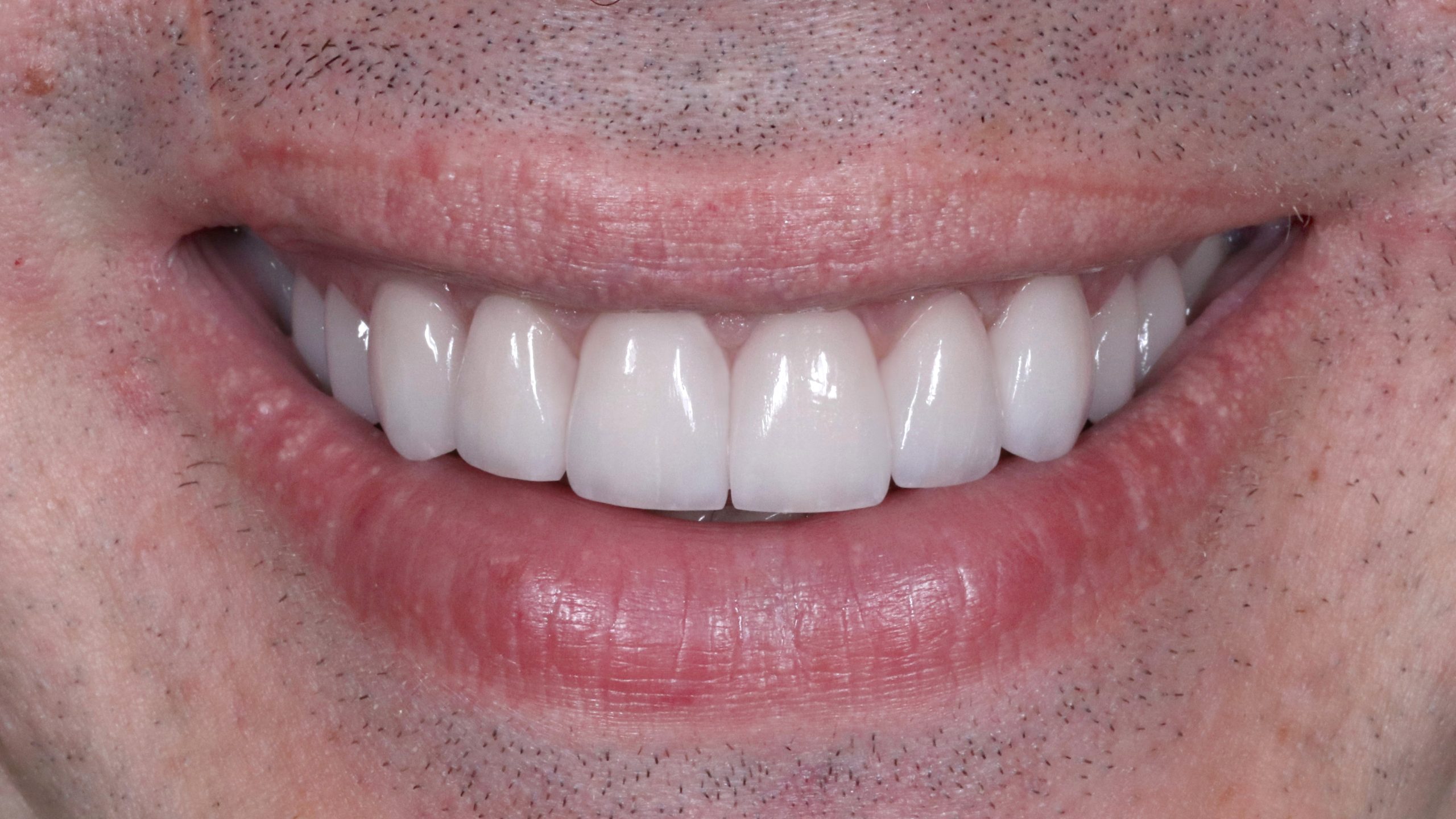 dental-veneers-treatment-result-veneer-after