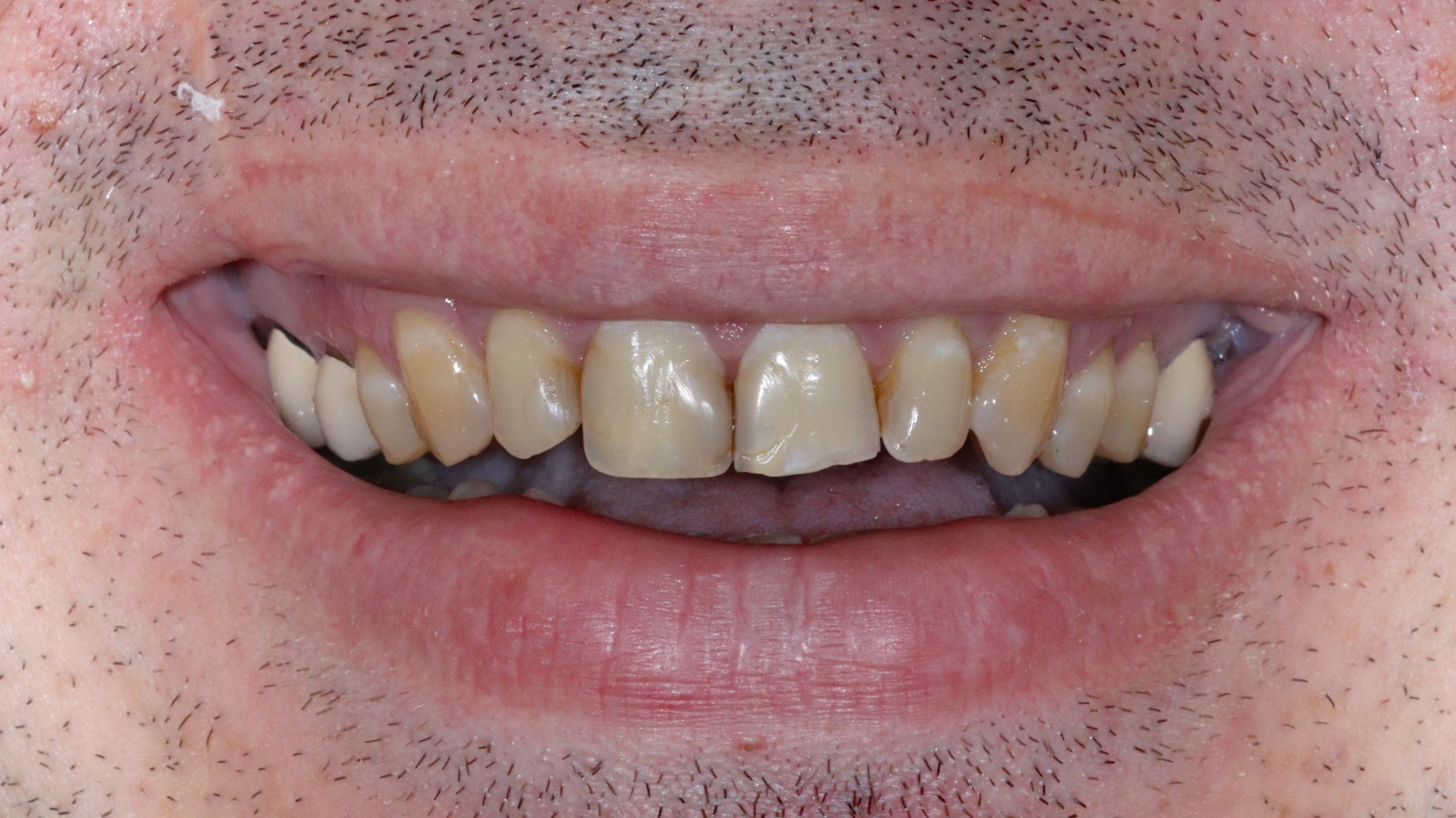 dental-veneers-treatment-result-veneer-before