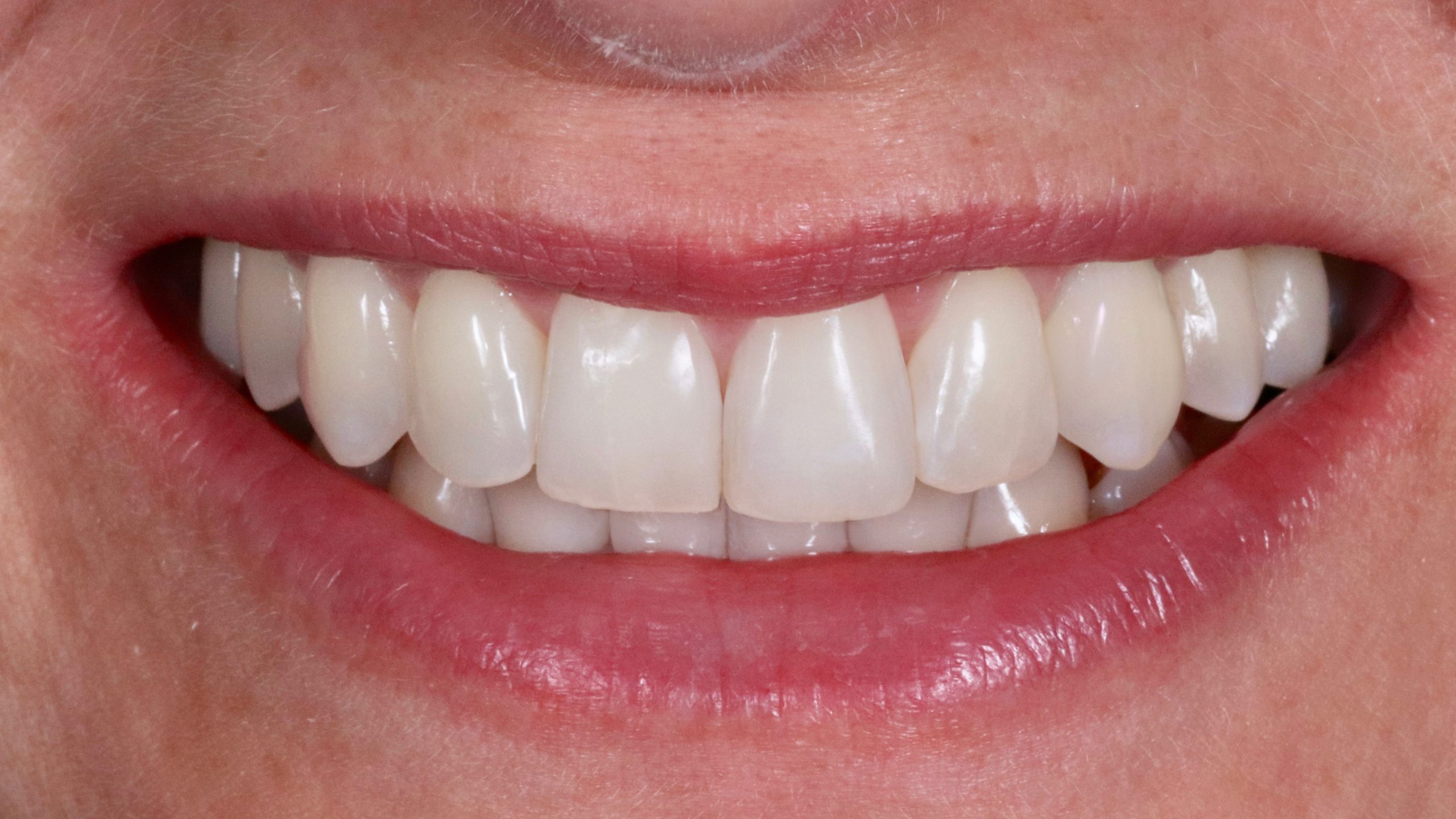 invisalign-und-bleaching-before-after-showcase-after