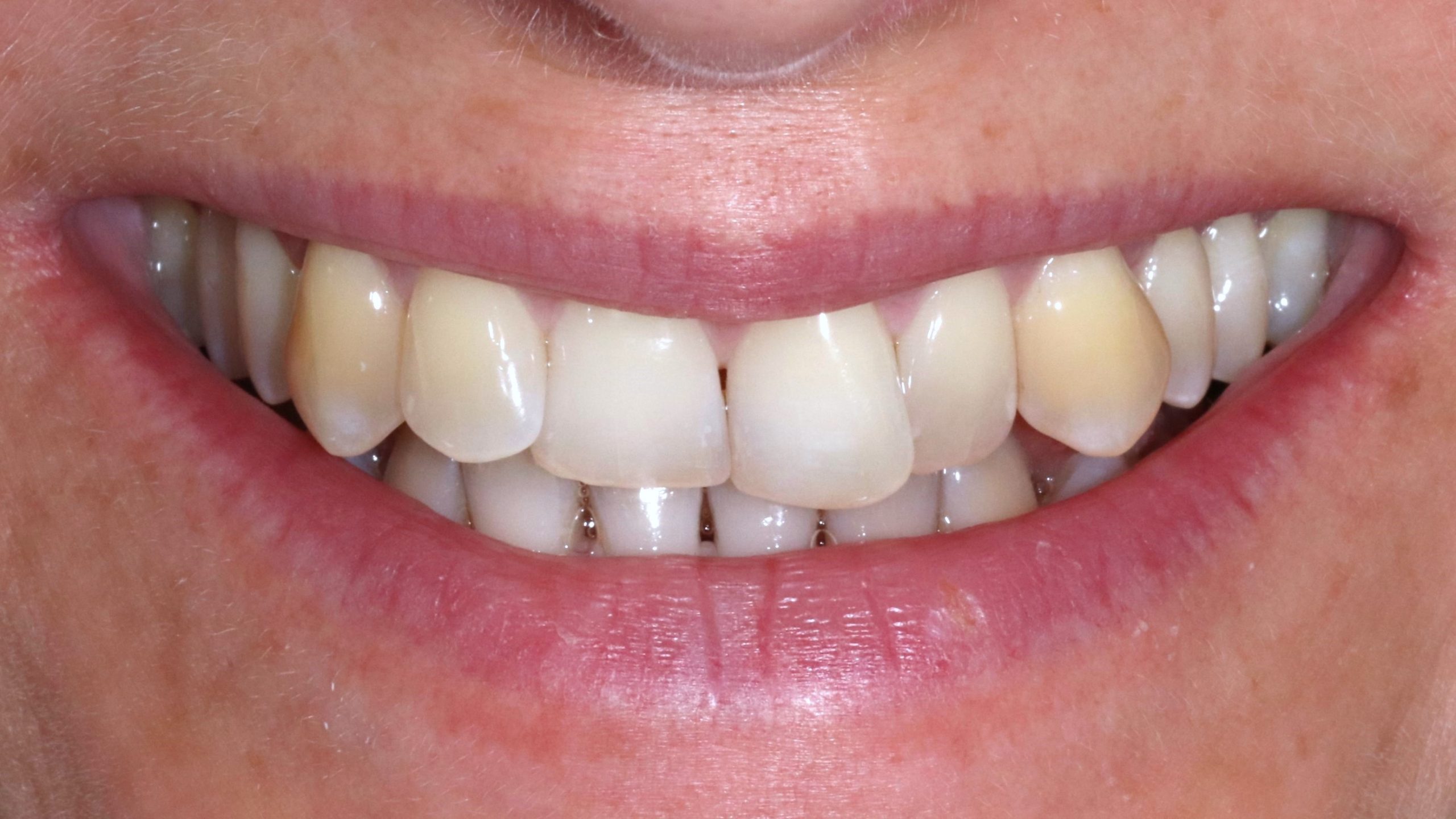 invisalign-und-bleaching-before-after-showcase-before