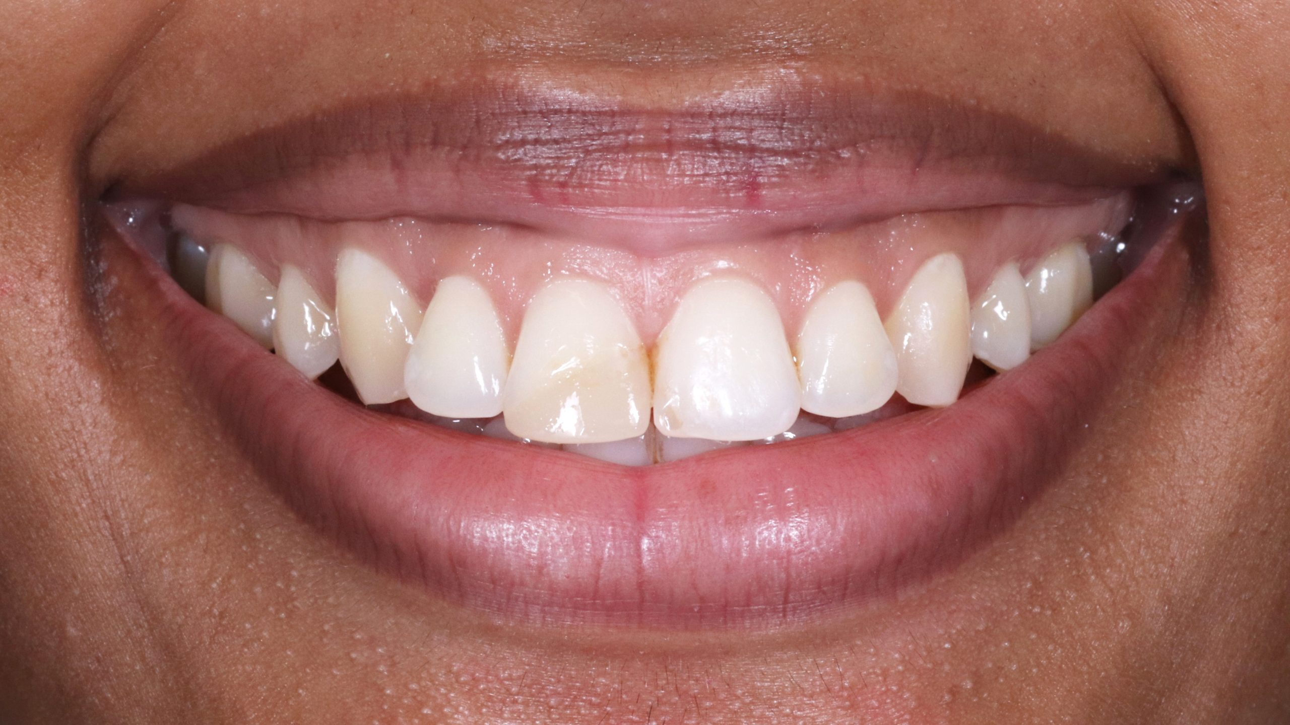 Minimalinvasive-Veneers-muenchen-zahnarzt-zahnbehandlung-vorher